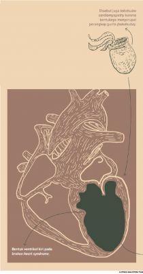 Sesaknya Gejala Sindrom "Patah Hati"